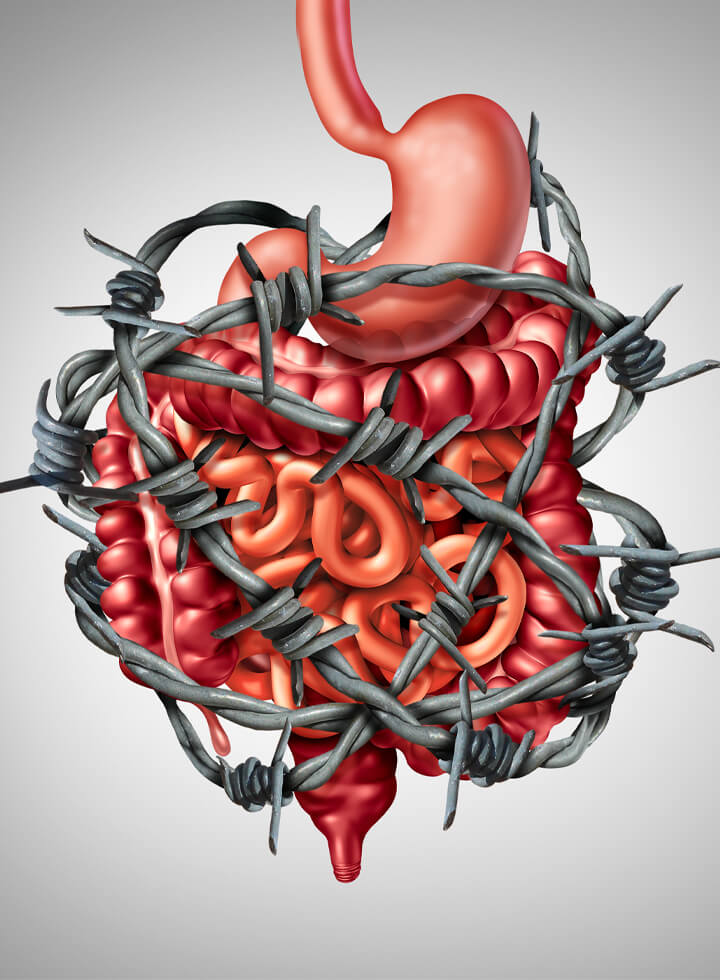 IBS